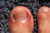 Possible Surgery and Ingrown Toenails