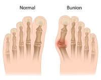 Treatment Options For Bunion